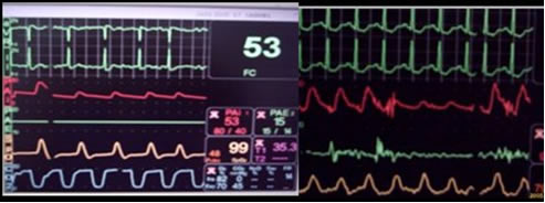 Corrigindo Arritmia- Fibrilação Atrial