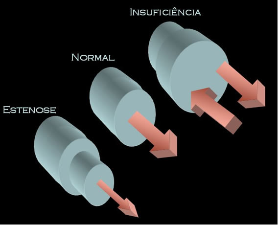Estenose e insuficiência valvar em relação ao fluxo de sangue. Estenose e insuficiência valvar em relação ao fluxo de sangue.