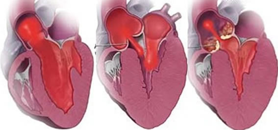 Valva aórtica normal, insuficiente e estenótica(com calcificação). Valva aórtica normal, insuficiente e estenótica(com calcificação).