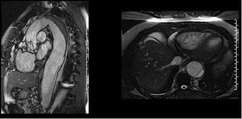 Dissecção de Aorta por RNM. Dissecção de Aorta por RNM.