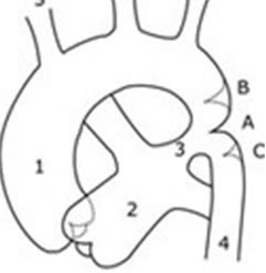 Coarctação de Aorta- A/B ou C. Coarctação de Aorta- A/B ou C.