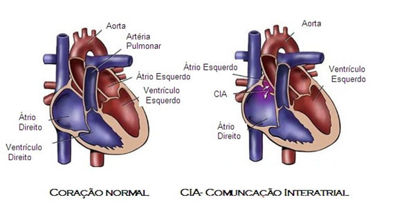 CIA- Comunicação Interatrial