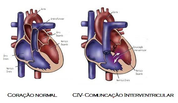 CIV- Comunicação Interventricular