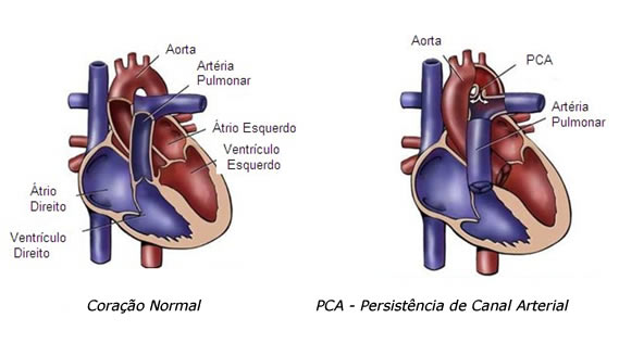 PCA – Persistência de Canal Arterial