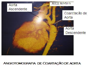 Coarctação de Aorta