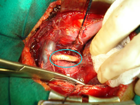 Cirurgia de Blalock-Taussig-Vivian com enxerto de PTFE Cirurgia de Blalock-Taussig-Vivian com enxerto de PTFE