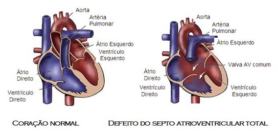 Defeito do Septo Atrioventricular